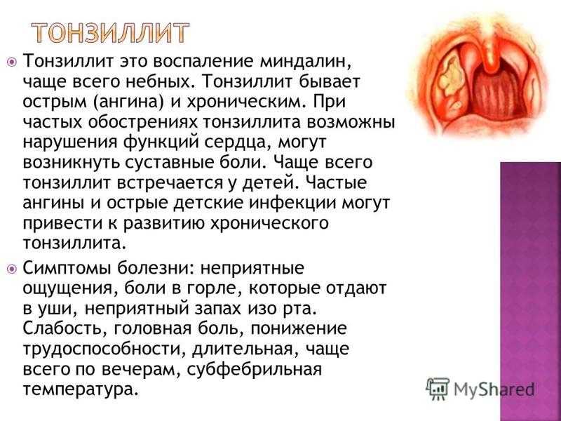 Чем лечить заднюю стенку. Воспаление острого хронического тонзиллита. Дифтерический фарингит. Болезни носоглотки тонзиллит.