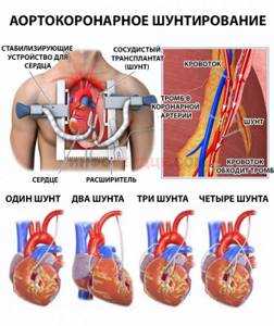 Шунтирование при ишемической болезни сердца!