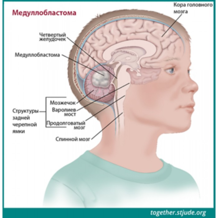 Опухоль головного мозга картинки
