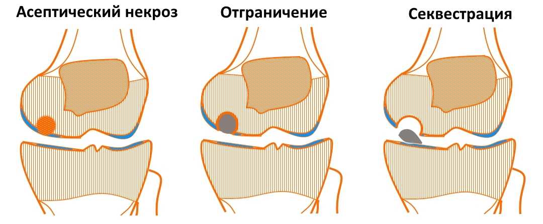 Симптомы и лечение болезни кенига (рассекающего остеохондроза суставных поверхностей) - medside.ru