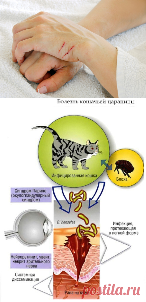 Болезнь кошачьих царапин (фелиноз, доброкачественный лимфоретикулёз). причины, симптомы, лечение и профилактика