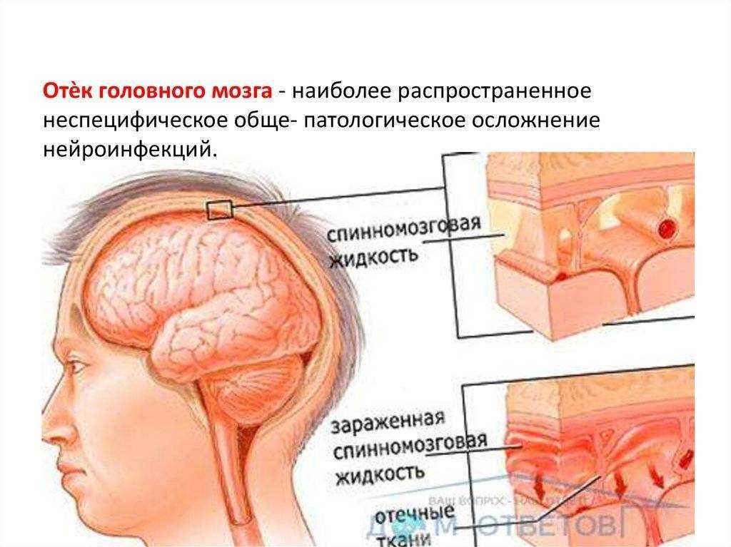 Отек головного мозга: причины, клиника, неотложная помощь