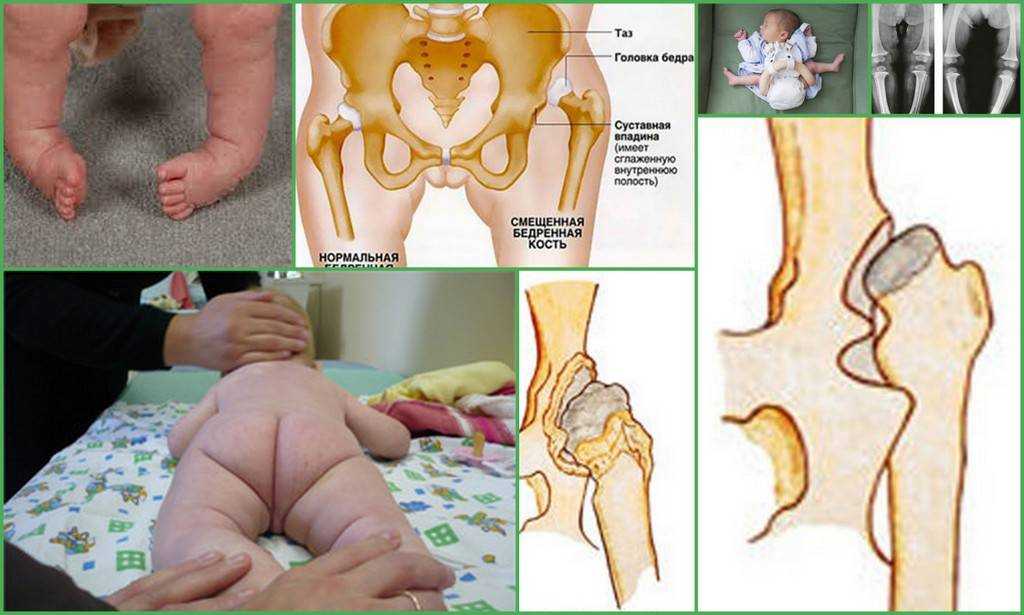 Что такое тбс. Дисплазия тазобедренных суставов у новорожденных 1б. Дисплазия ТБС У ребенка рентген. Доктор Комаровский дисплазия тазобедренных суставов. Нелеченная дисплазия тазобедренных суставов у детей.