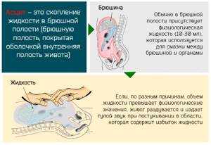 Лечение асцита при раке за границей | цена от 839$ | 55 клиник
