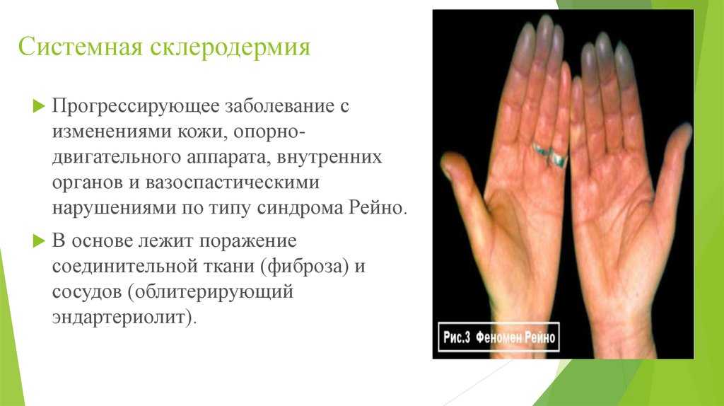 ᐈ что такое пиодермия? ~【лечение】