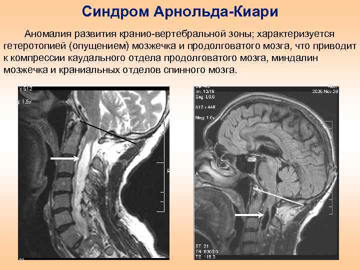 Аномалия арнольда киари что это