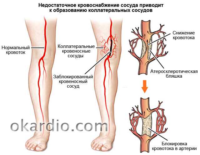 Лечение сосудистой недостаточности
