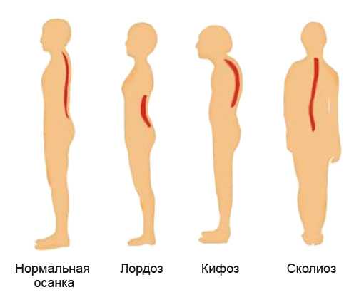 Патологический кифоз отделов позвоночника: лечение и профилактика