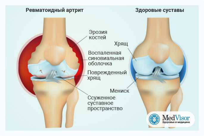 Ревматоидный артрит коленного сустава фото