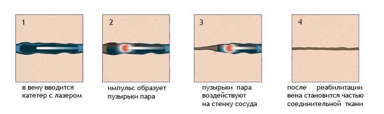 Лазерная облитерация вен нижних. Эндовазальная лазерная коагуляция варикозных вен. ЭВЛК лазерная коагуляция варикозных вен. Минифлебэктомия склеротерапия.