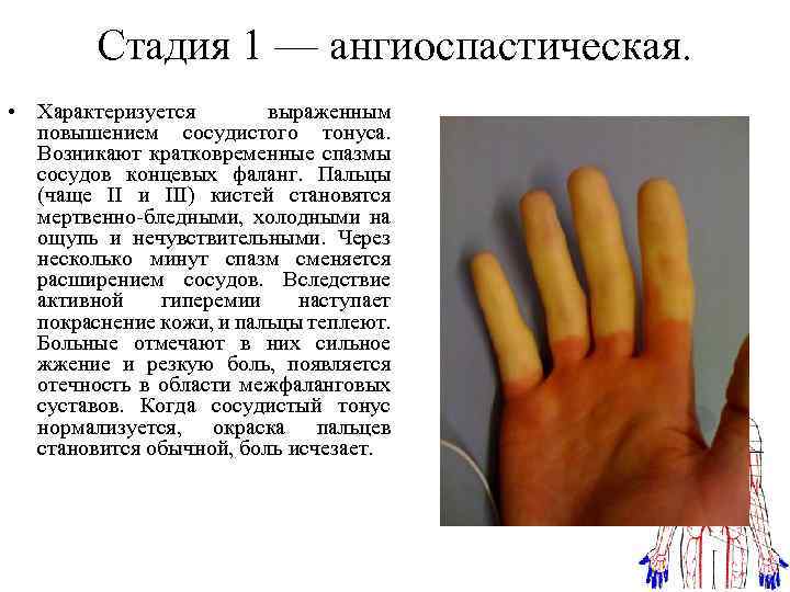 Озноб