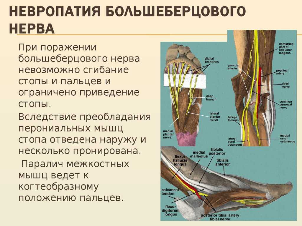 Невропатия бедренного нерва - симптомы болезни, профилактика и лечение нейропатии бедренного нерва, причины заболевания и его диагностика на eurolab