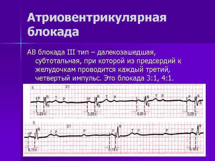 Атриовентрикулярная блокада признаки. Полная атриовентрикулярная блокада 3 степени на ЭКГ. Атриовентрикулярная блокада степени на ЭКГ. ЭКГ АВ блокада 1. АВ блокада 2 степени 1 типа 3:1.