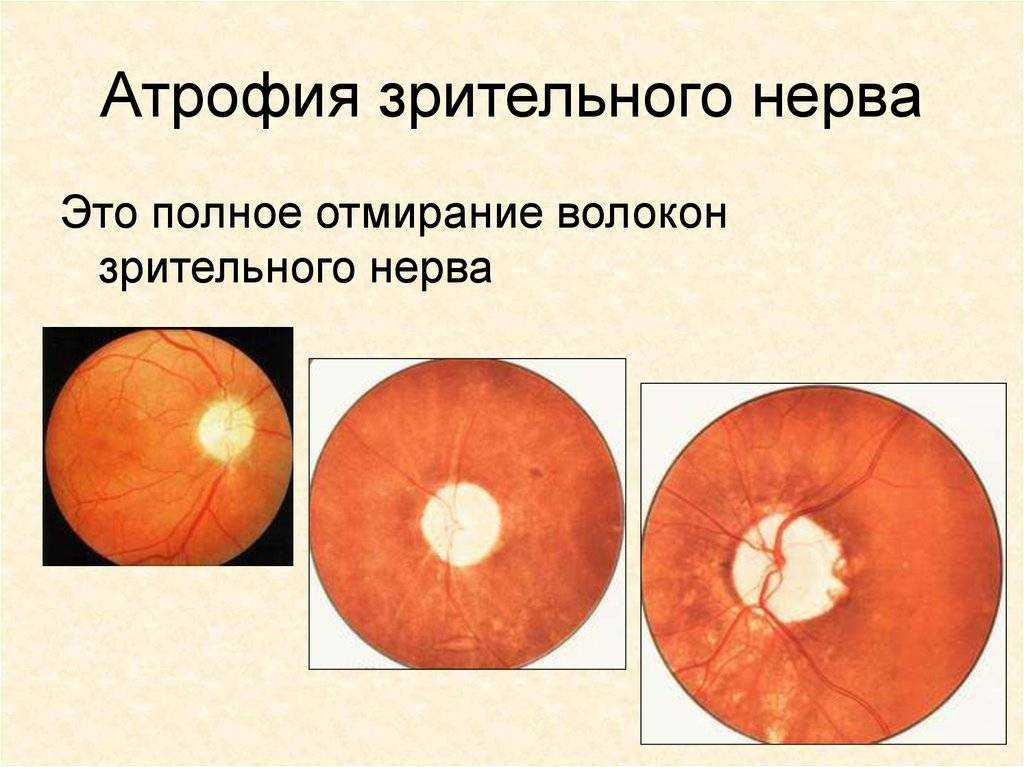 Поражение зрительного. Атрофия зрительного нерва Тип наследования. Омертвление зрительного нерва. Причины развития атрофии зрительного нерва. Перечислите основные причины развития атрофии зрительного нерва..