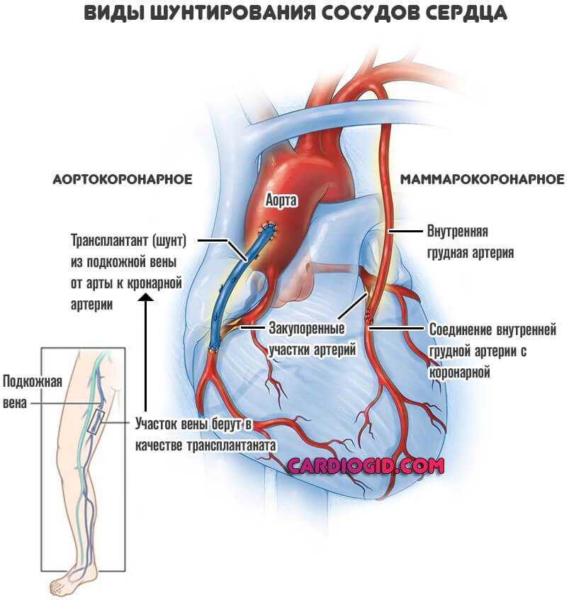 Что такое шунтирование сердца и сосудов. Шунтирование коронарных артерий. Схема операции аортокоронарного шунтирования. Стентирование коронарных артерий схема. Операция шунтирование сосудов сердца.