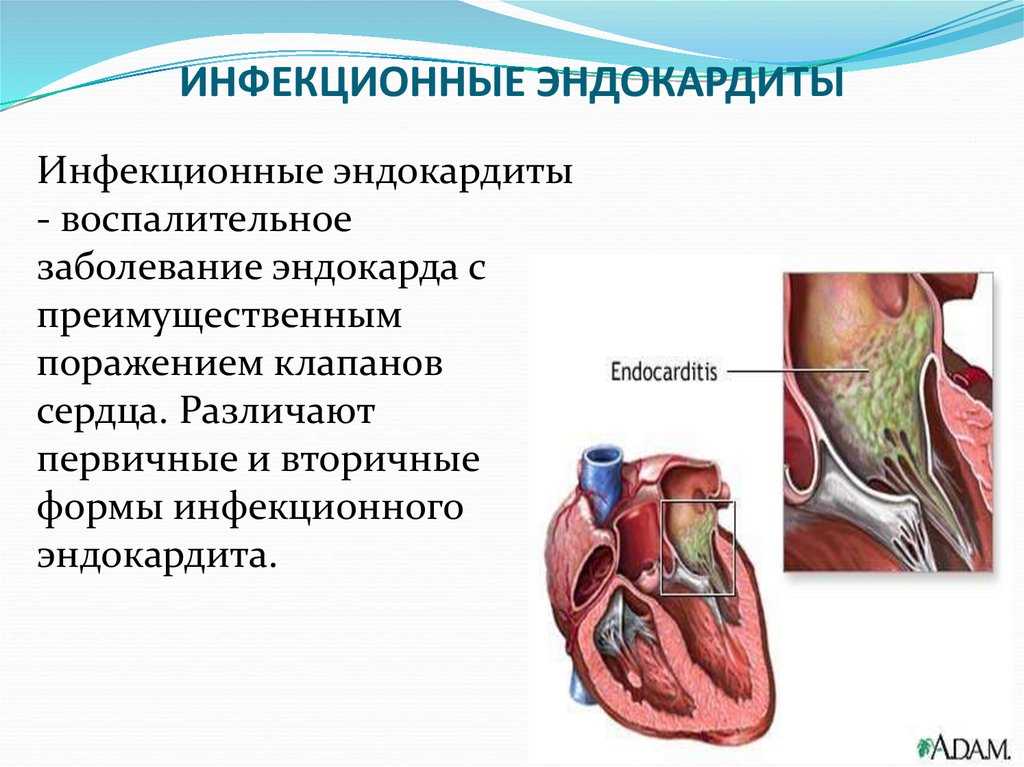 Эндокардит клинические рекомендации