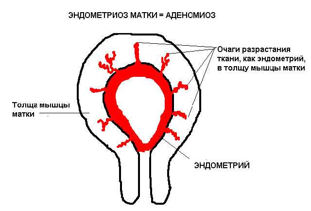 Аденомиоз