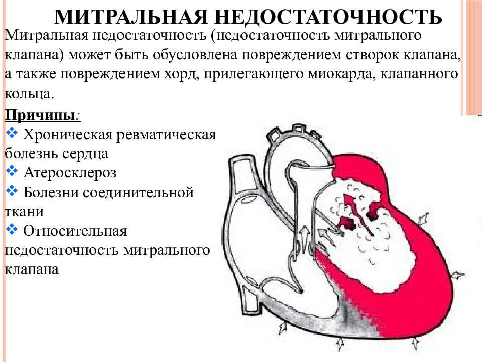 Митральная недостаточность гемодинамика