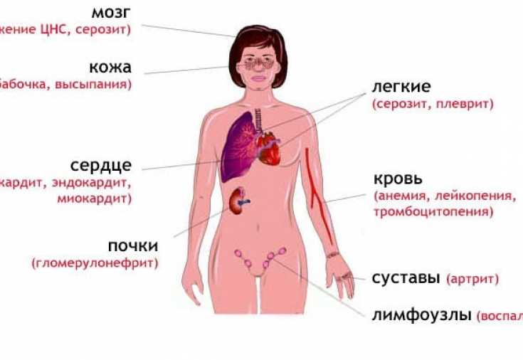 ᐈ что такое волчанка? ~【симптомы, лечение】