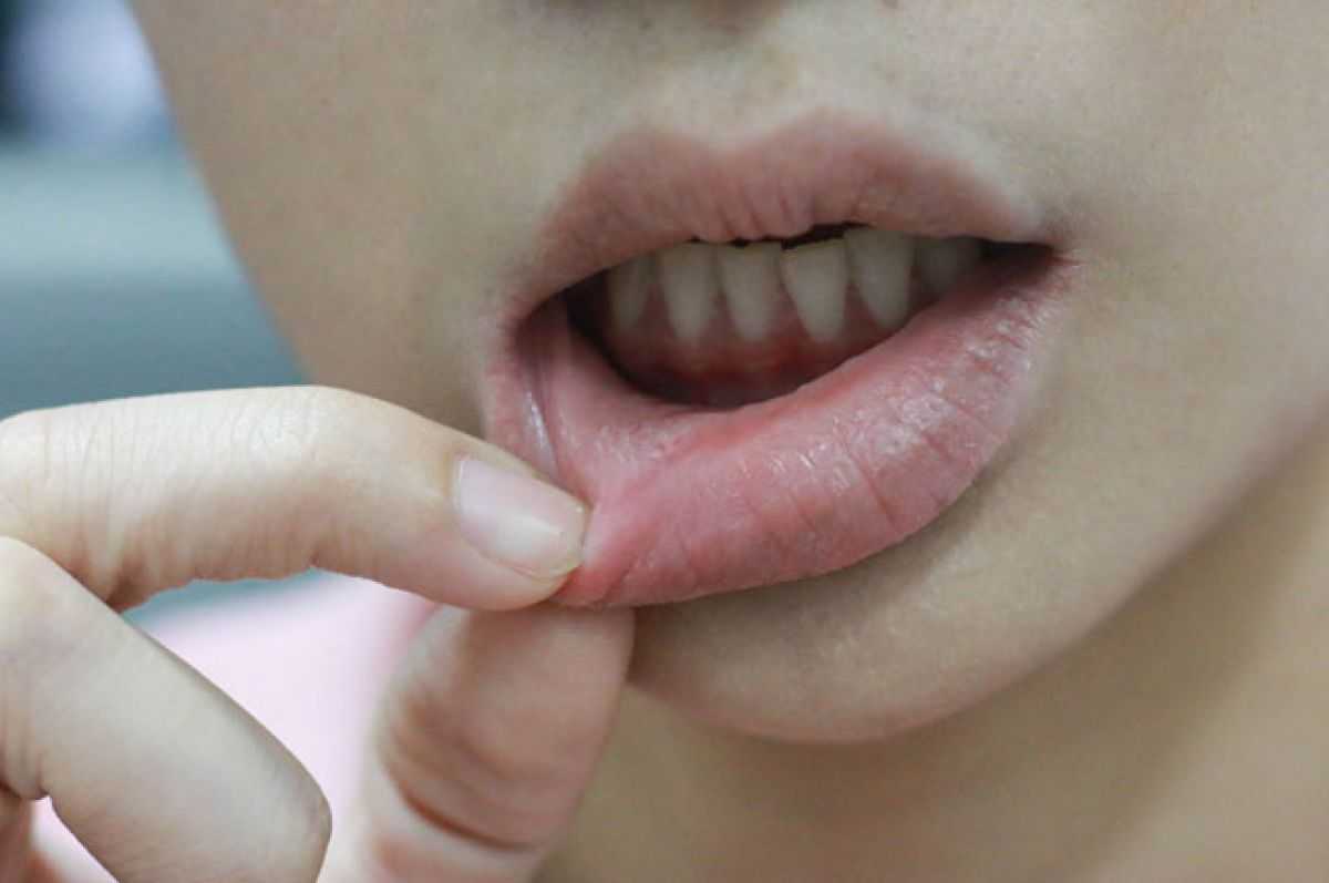Инфекции полости рта: виды, причины, лечение