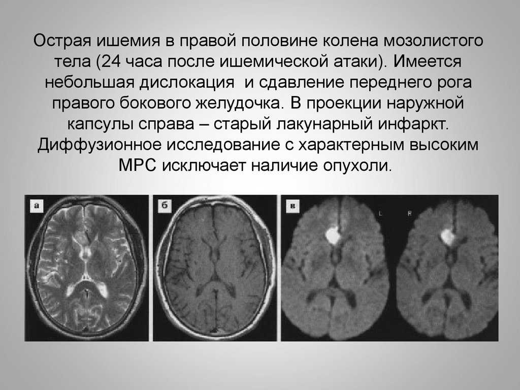 Глиоз головного мозга: причины, признаки, диагностика, лечение