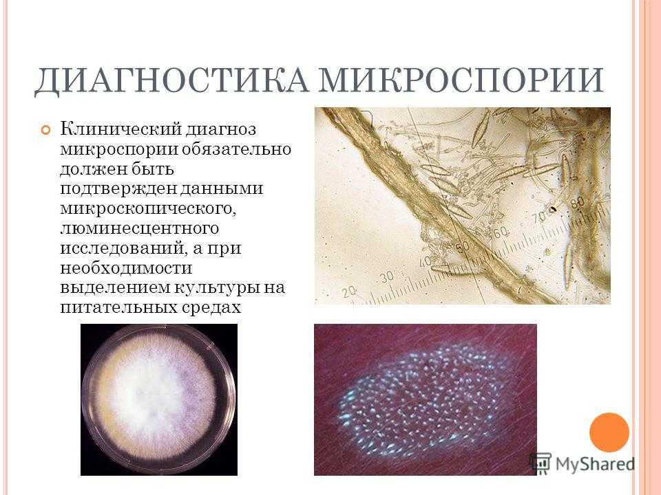 На коже обнаружены споры. Микроскопия трихофития на гладкой коже. Микроспорум Канис микроскопия. Микроскопия микроспория кожи. Микроспория антропофильная.