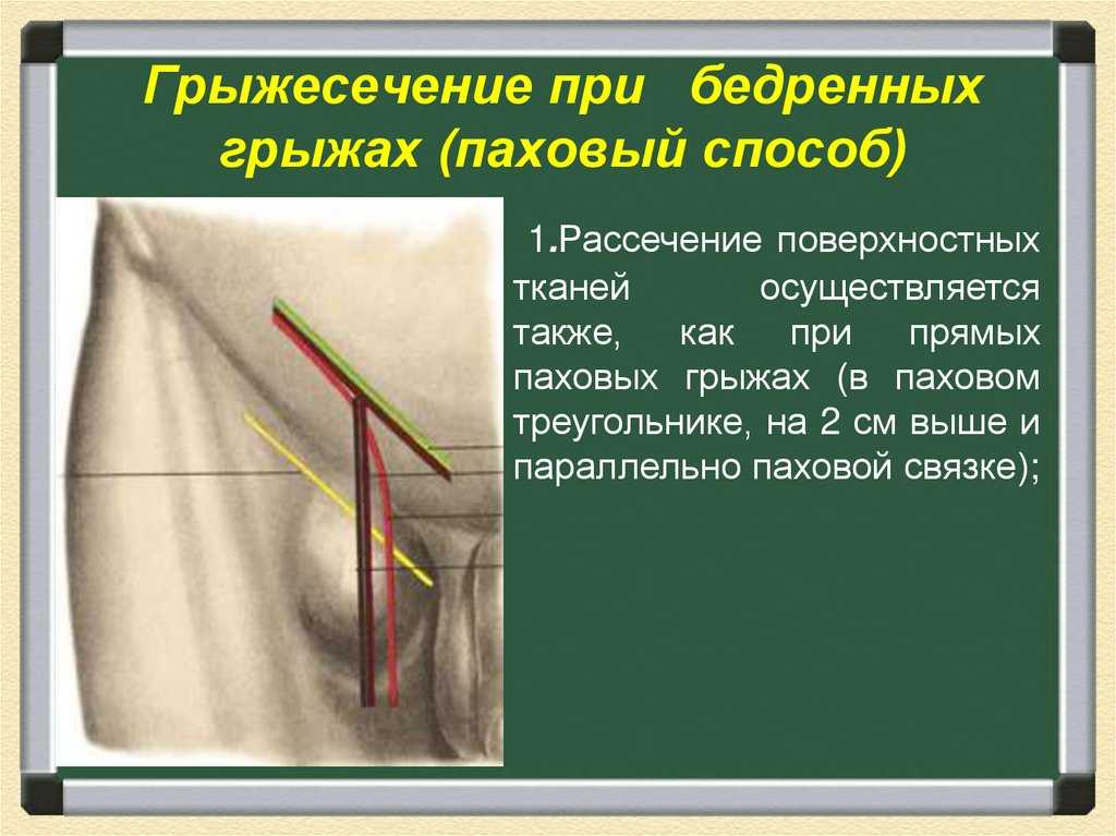 Бедренная грыжа картинки