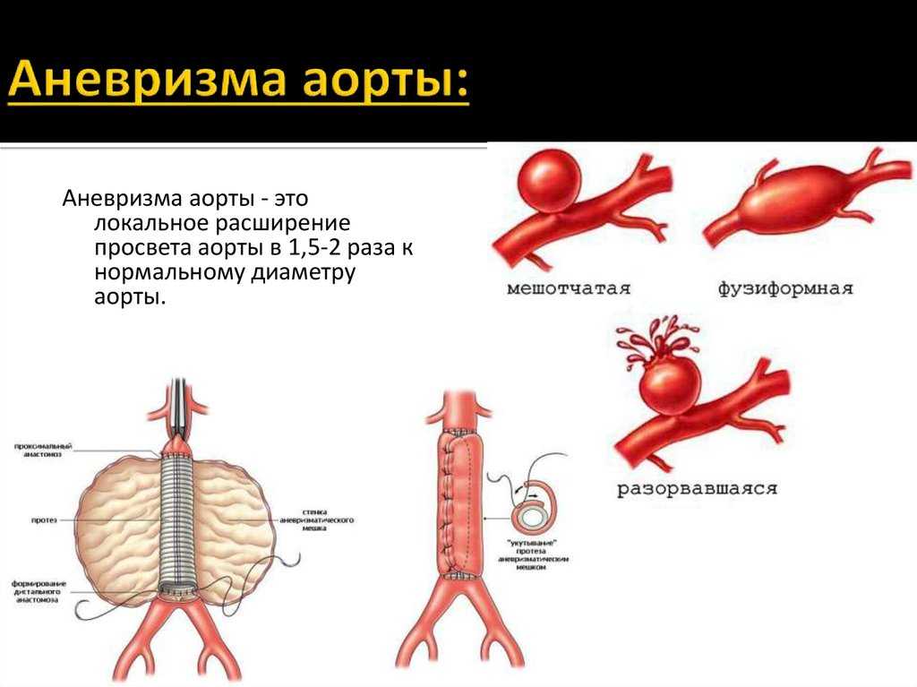 Аневризма отдела аорты. Ложная аневризма грудной аорты. Веретенообразная аневризма брюшной аорты. Аневризма восходящего отдела грудной аорты. Веретеновидная аневризма грудной аорты.