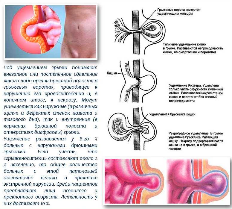 Пупочная грыжа рисунок схема