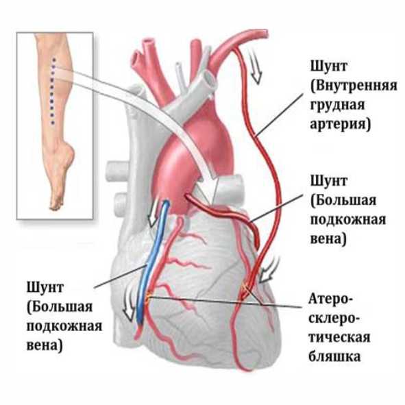 Коронарное шунтирование сосудов сердца. Аортокоронарное шунтирование ЗМЖВ. Аортокоронарное шунтирование внутренняя грудная артерия.
