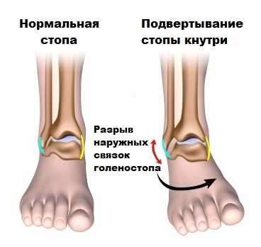 Повреждение сустава: менисков, связок
