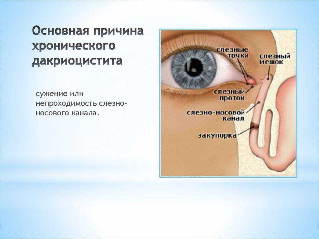 Воспаление слезной железы