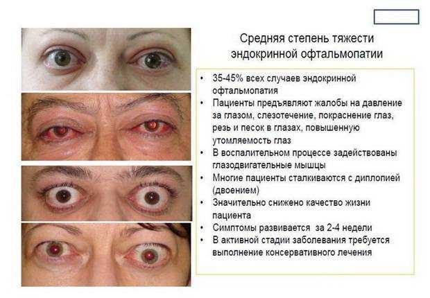 Эндокринная офтальмопатия: причины, симптомы, лечение