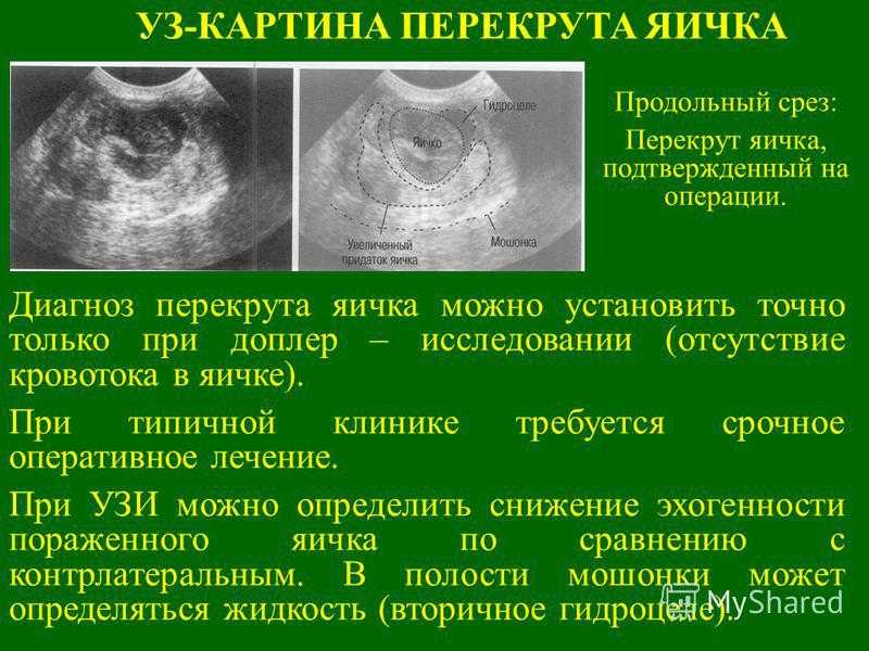 Всё о перекруте яичка у мальчиков - статьи - клиника «c нуля» (здоровая семья)