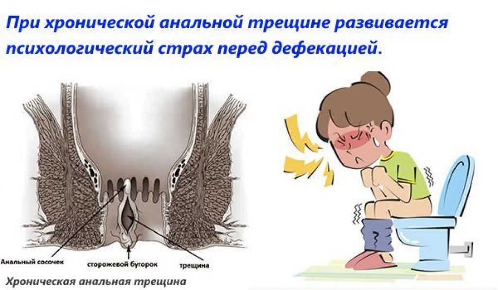 Операция по иссечению анальной трещины: боль при дефекации, что делать для восстановления, диета
