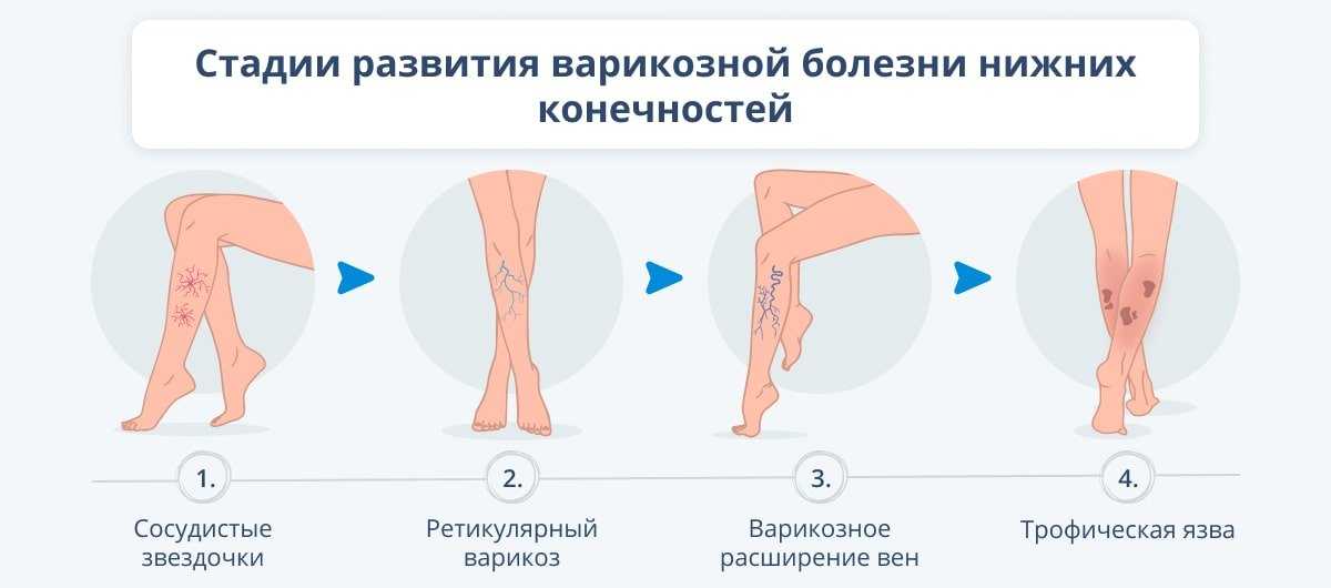 Варикозная болезнь нижних конечностей - причины, симптомы, стадии, диагностика и лечение
