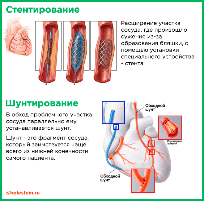 Шунтирования сердца сколько реабилитация длится