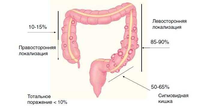 Дивертикулез сигмовидной кишки симптомы и лечение. Дивертикулы ободочной кишки классификация. Дивертикулярная болезнь толстой кишки клинические. Дивертикулит сигмовидной кишки. Осложнения дивертикулеза толстой кишки.