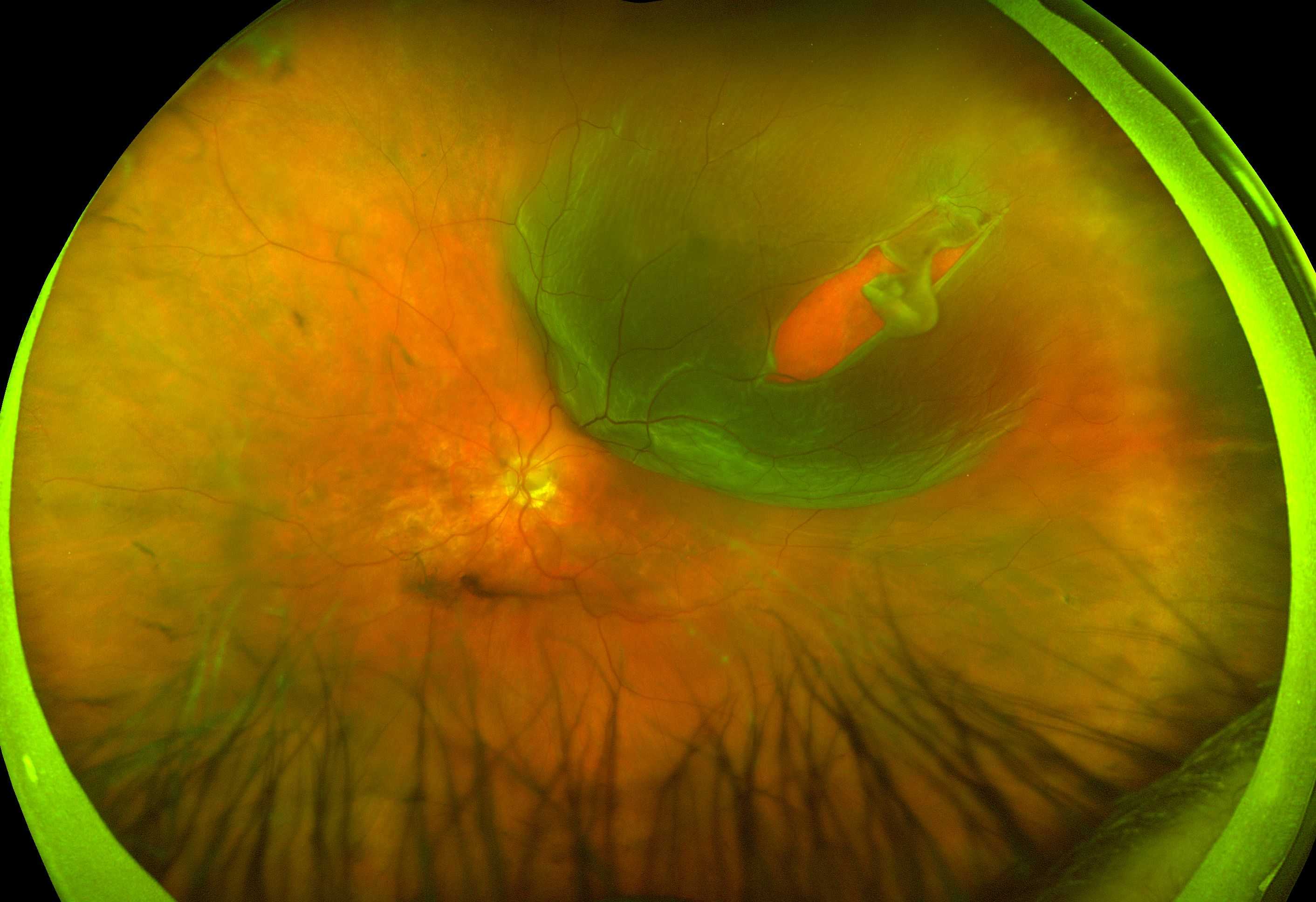 Макулопатия глаза. Инееподобная дегенерация сетчатки. Отслойка сетчатки глазное дно. Периферическая витреохориоретинальная дегенерация сетчатки глаза. Разрыв сетчатки (retinal tear).