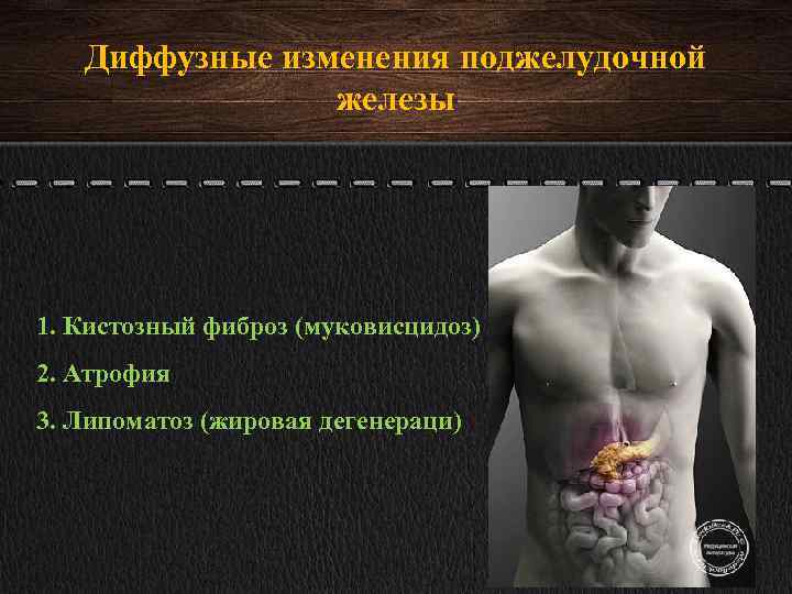 Стеатоз печени и поджелудочной железы