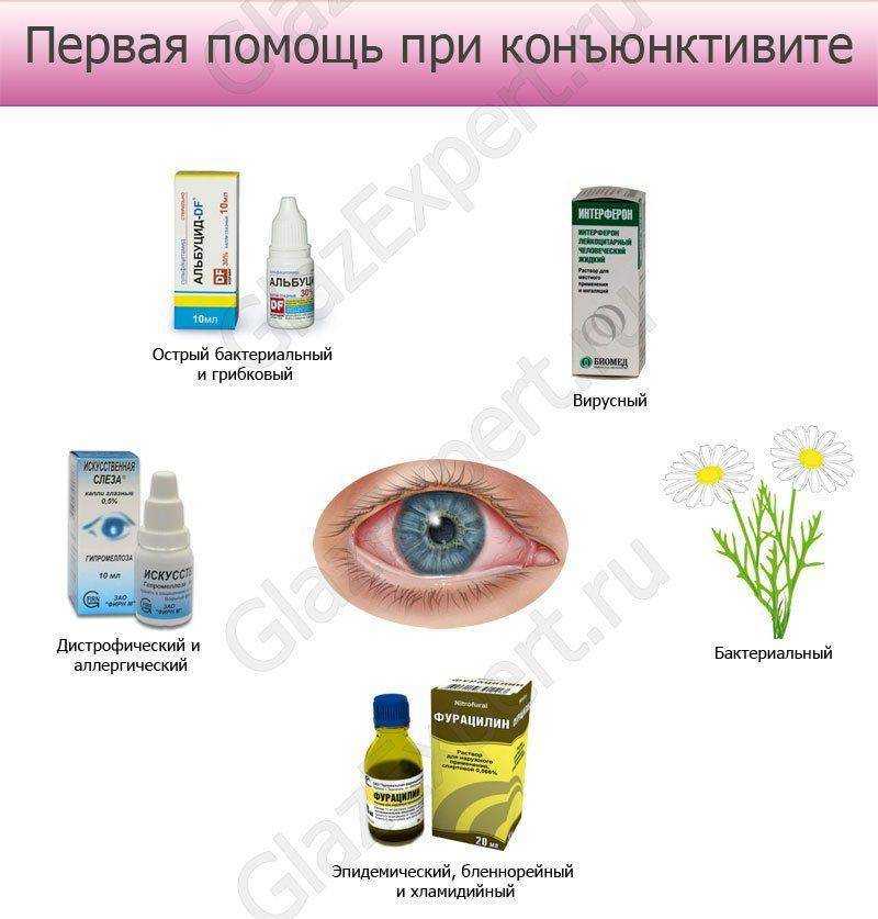 Конъюнктивит: симптомы и лечение бактериальных, вирусных, аллергических конъюнктивитов