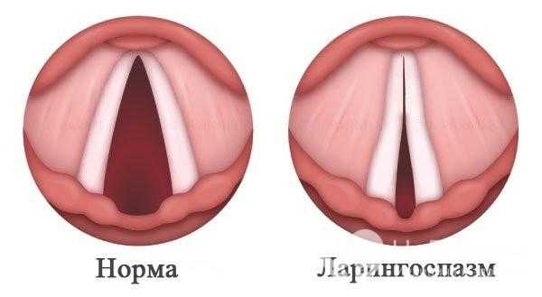 Почему происходит спазм гортани?