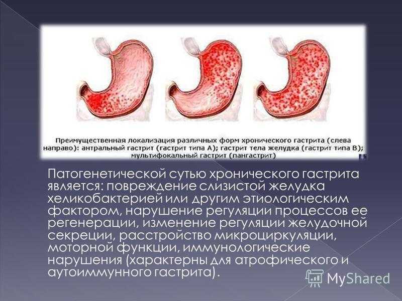 Хронический гастрит и гастродуоденит