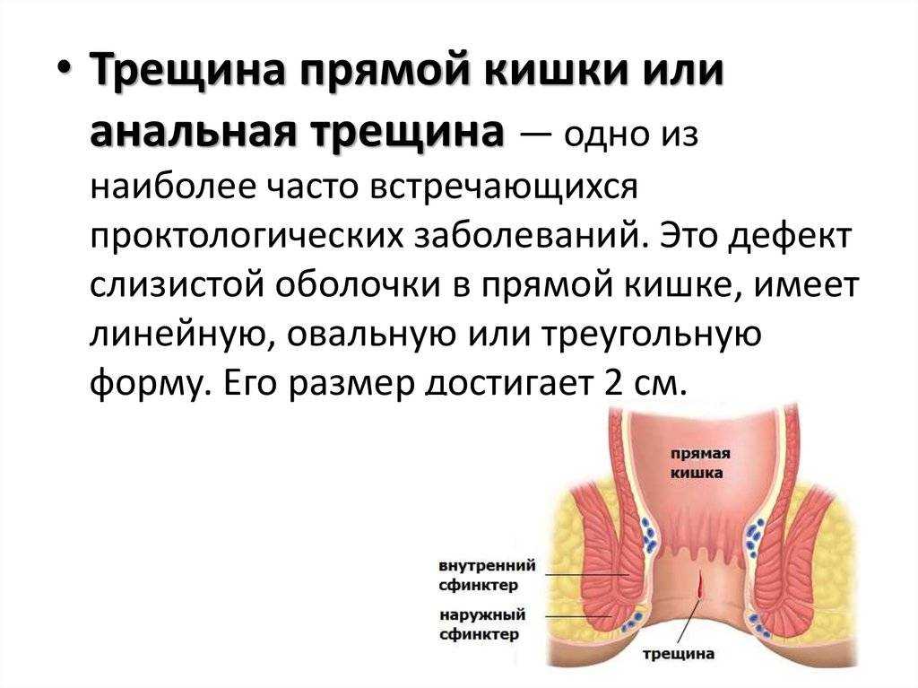 Лазерное удаление геморроя - как происходит, к чему нужно готовиться
