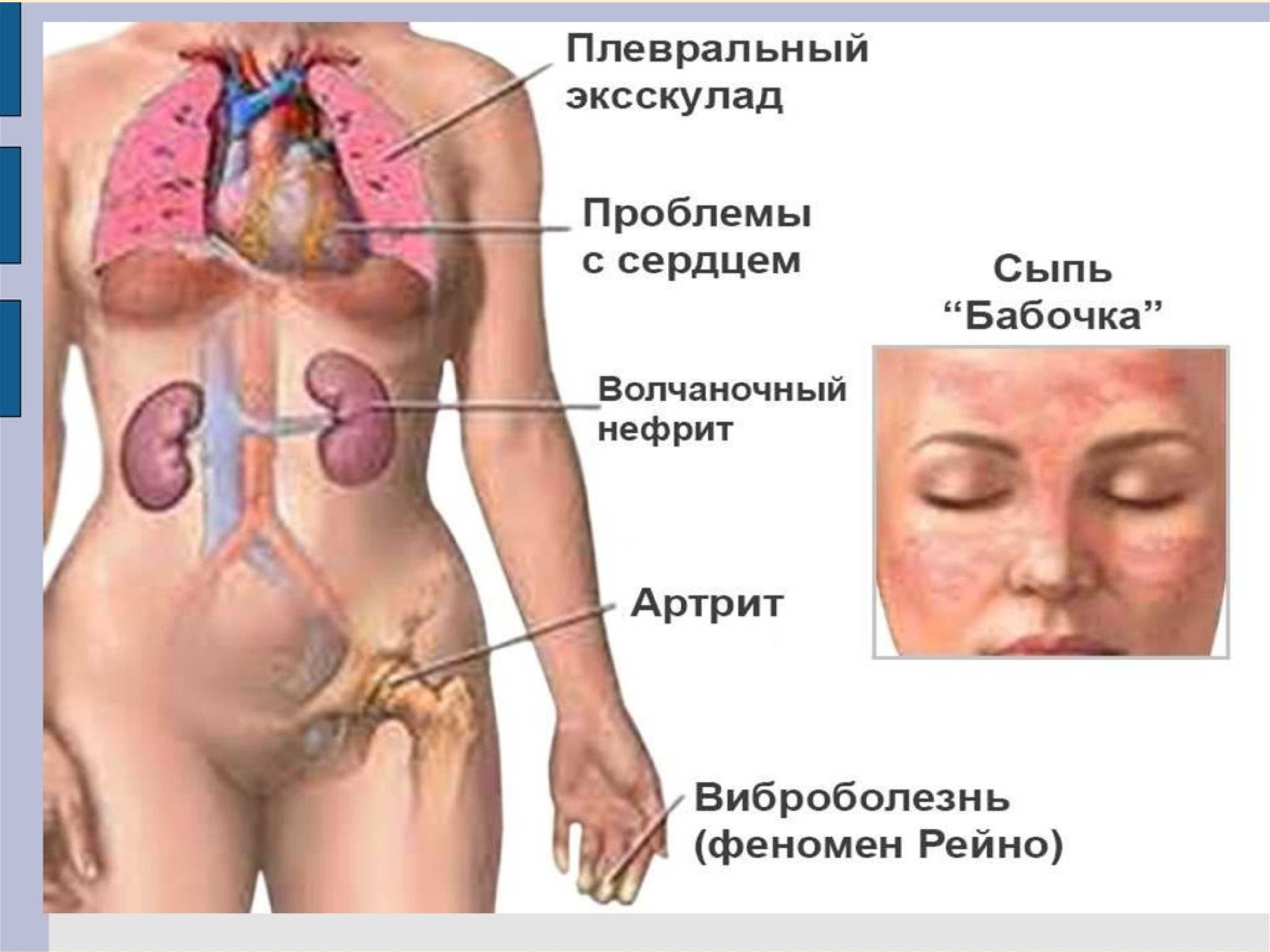 Симптомы и лечение системной красной волчанки   - medside.ru