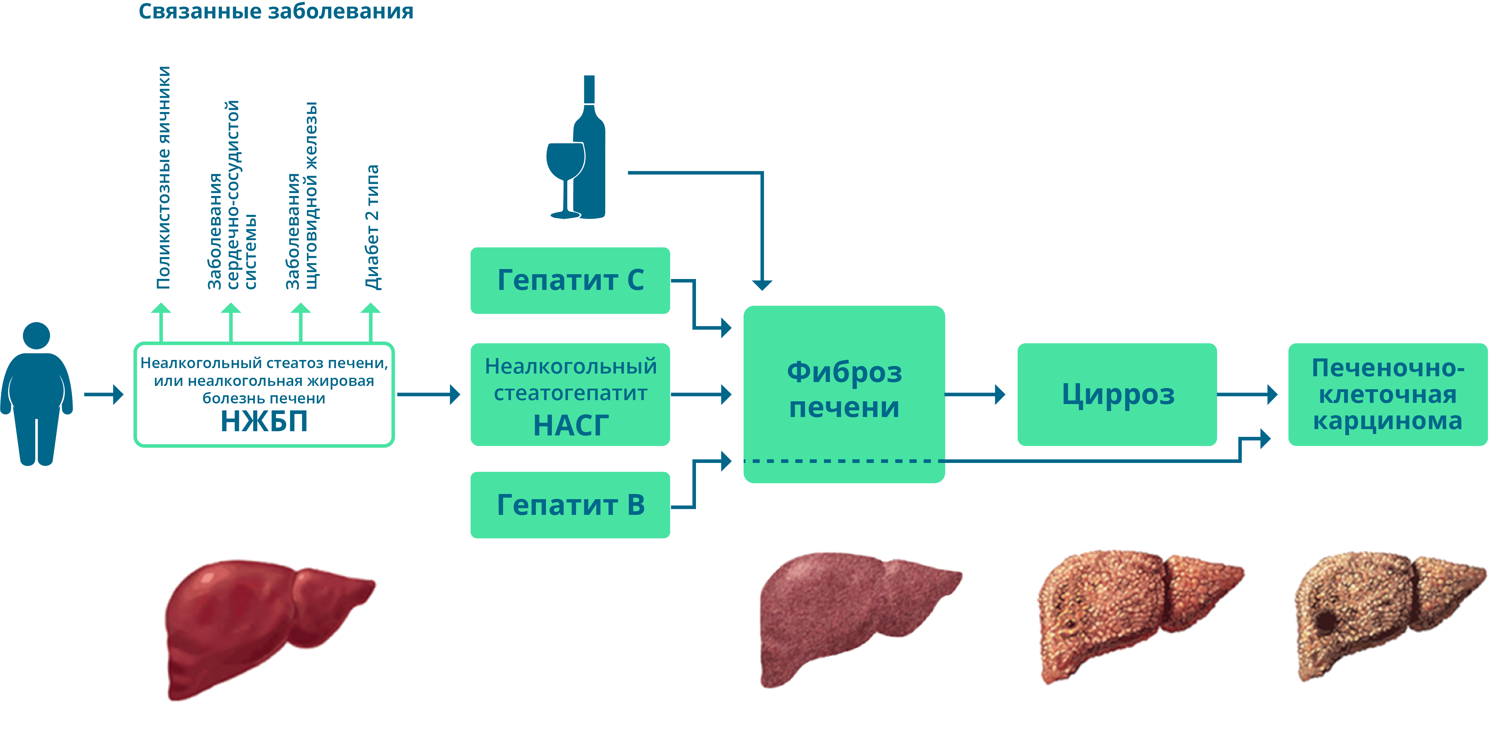 Признаки стеатоза печени. Схема лекарств при стеатозе печени. Стадии стеатоза печени. Болезнь печени стеатогепатоз.