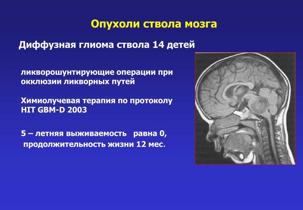 Рак ствола головного мозга. Характерный симптом опухоли ствола мозга:. Объемное образование ствола головного мозга. Диффузная глиома ствола мозга.
