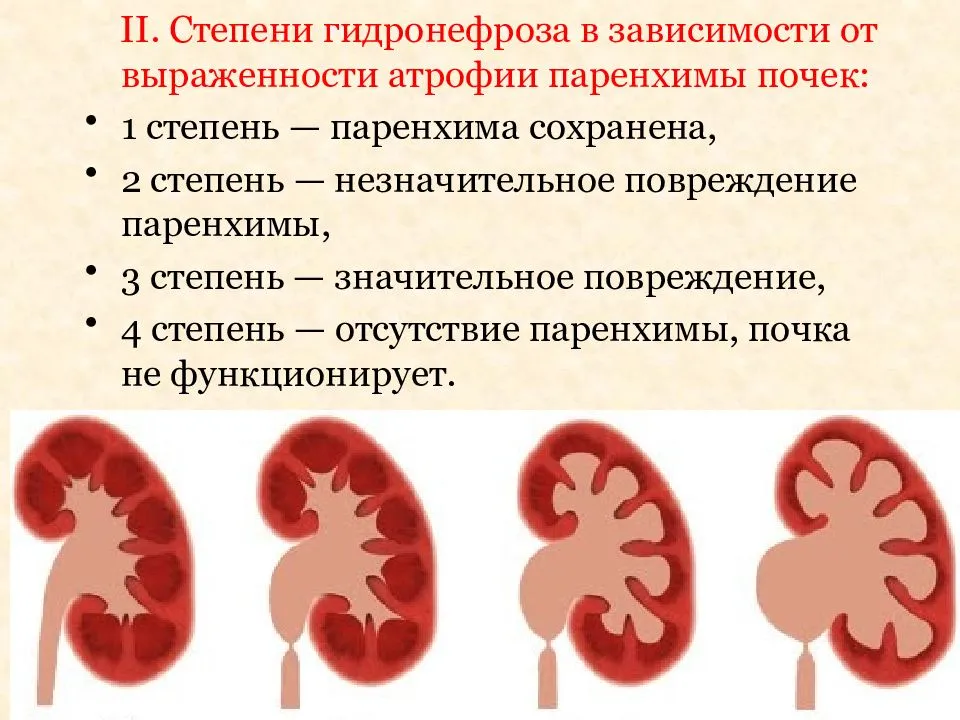 Гидронефроз презентация урология