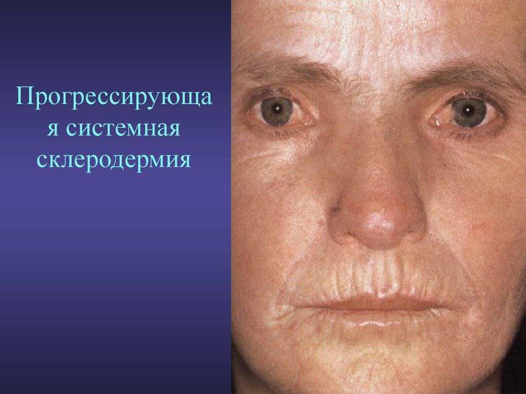Ограниченный нейродермит: причины, симптомы и лечение