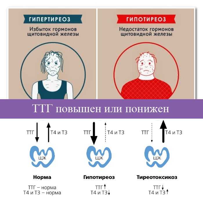 Жизнь после удаления щитовидной железы у женщин